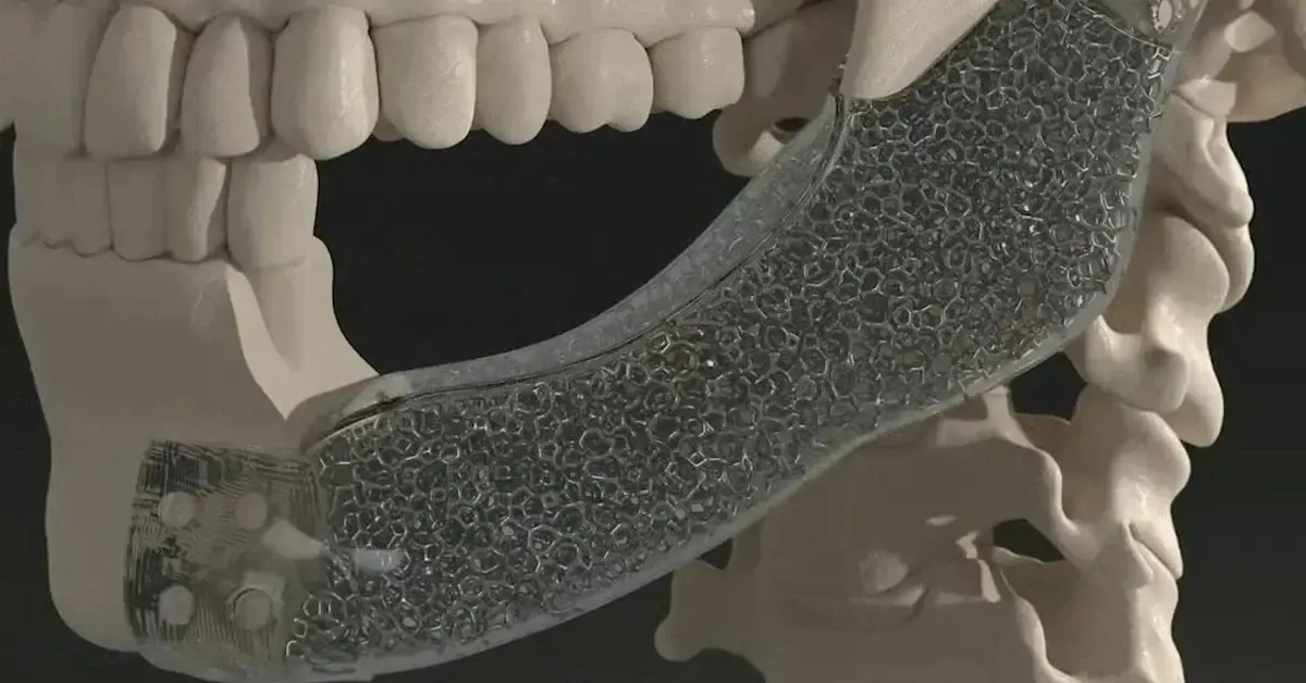 Lattice-structured jaw implant on a skull model